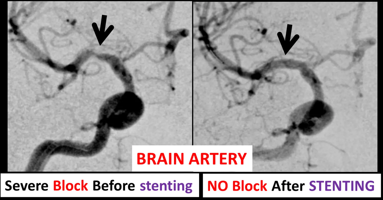 Brain_Artery